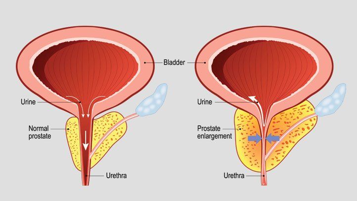 prostate health issue how to shrink enlarged prostate