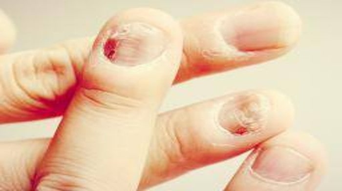 Solution to Fungus Nail Infection