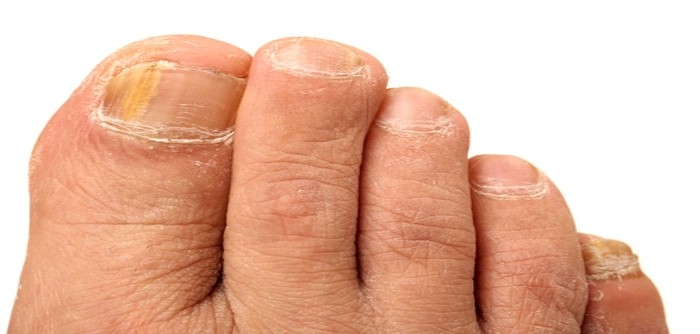 best toenail treatment from official website