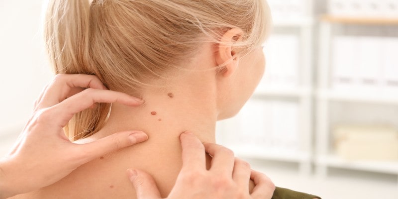 Natural Way to Remove Skin Tags without stressing yourself