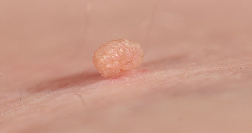Best way to remove skin tags skintology from official website